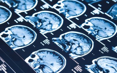 Parkinson’s Disease and Related Disorders
